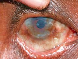 Image result for Vernal Conjunctivitis