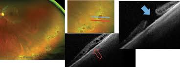 This advancement allows doctors to see 82 percent of the retina in a single capture, and. A Field Guide To Retinal Holes And Tears