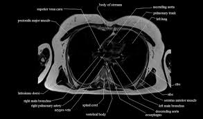 Normal anatomic structures are labeled on posteroanterior (pa) and lateral chest radiographs (figs. Chest Anatomy Mri Chest Thorax Axial Anatomy Free Cross Sectional Anatomy
