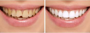 A thin sheet of rubber, called a rubber dam, is placed in the mouth and around the base of the tooth to isolate the tooth and help to keep the operative field dry. Is It Any Special Precautions That Need To Be Taken After Root Canal Treatment