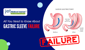 Ive heard talk about resetting the sleeve is this a real thing? Gastric Sleeve Failure Can A Gastric Sleeve Be Redone
