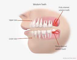 Removing all four wisdom teeth at once can cost anywhere between $300 and $2500. Wisdom Tooth Surgery In Hamburg Germany Zahnklinik Abc Bogen