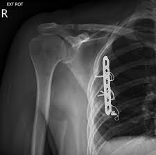 Image result for Scapulothoracic Injection