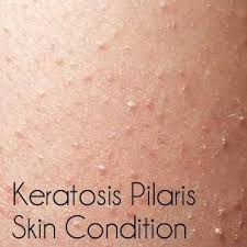 Keratosis Pilaris Bumps On Skin Babywise Mom Skin Bumps Keratosis Pilaris Rough Bumpy Skin