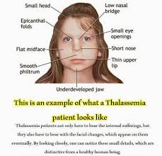 Thalasemia adalah penyakit kelainan darah turunan yang memengaruhi kadar hemoglobin darah. Apakah Penyakit Talasemia Monolog Kakmim