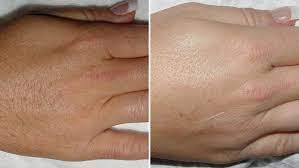 No more painful waxing, electrolysis or razors! Coolglide Laser Hair Removal Lakes Dermatology