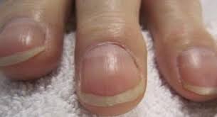 Nephritis is an inflammatory kidney disease and has several types according to the location of the. Top 10 Reasons For Brittle And Deformed Nails Thehealthsite Com