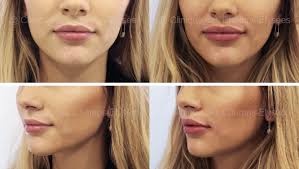 Aujourd'hui un training à pratiquer sans modération pour effacer les rides du contour de l'œil, repulper les lèvres et remonter les paupières tombantes. Injection Levres A Paris Seance Et Prix Clinique Des Champs Elysees