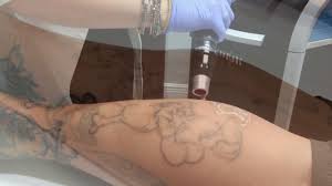 Tattoos | classic ink tattoo studio. Video Tattoo Removal With Laser