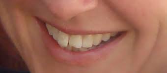 Within two weeks most people are back to normal except some of your food selections may have to change of having the added hardware in your mouth. I Had Lingual Braces At 45 And This Is What Happened Healthista