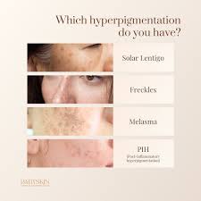 Image result for Solar Lentigo