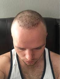 The hair which is shed generally grows back together with the transplanted hair beginning at about three months. Possible Shock Loss I Had 2500 Grafts Taken Through Fue Method Photos