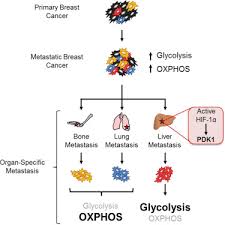 Breast pain can be a symptom of cancer. Pdk1 Dependent Metabolic Reprogramming Dictates Metastatic Potential In Breast Cancer Sciencedirect