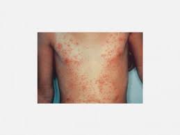 Beyaz deniz anaları zararlı mıdır? Deniz Canlilarinin Neden Oldugu Cilt Reaksiyonlari