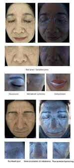 Skin Analyzer Malaysia Skin Observed System Skin Analysis