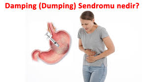 Dumping sendromunu tedavisinde öncelikle beslenme alışkanlıklar değiştirilmelidir. Damping Dumping Sendromu Nedir