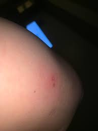 As the venom spreads, this blistering effect will also progress. Could This Be A Brown Recluse Bite Brownreclusebites
