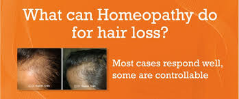 Hair loss treatment how hair loss in men affects self esteem natural remedies for hair loss and thinning Homeopathic Medicine For Hair Loss And Hair Fall Control For Men Women At Life Force Homeopathy Clinics
