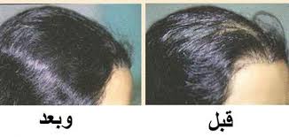 انواع الزيوت للشعر المتساقط 0540428830 زيت الحشيش الأفضل أهل السعودية Saudia10