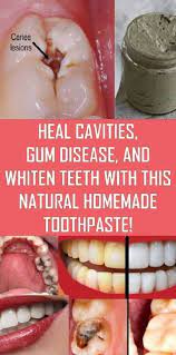Heal Cavities Gum Disease And Whiten Teeth With This Natural Homemade Toothpaste Heal Cavities Homemade Toothpaste Teeth Health