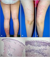 Image result for pruritic urticarial papules and plaques of pregnancy
