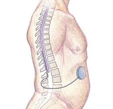 Image result for Intrathecal Pump