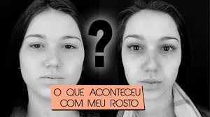 A amigue dela, jennifer aniston, também fez bichectomia. Contei Tudo Sobre A Minha Bichectomia Antes E Depois Youtube