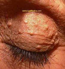 Image result for milium cyst on eyelid