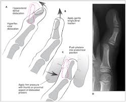 Image result for Lateral PIP Dislocation