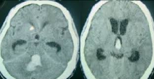 Emorragia in una cavità del cavernoma: Gestione Degli Accidenti Vascolari Cerebrali In Fase Acuta Sciencedirect