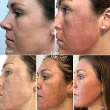 What a difference 5 days can make ... 🙌😍 These results we're achieved  after just 1 treatment of Fraxel Laser!! ONE!! ☝️ Perfect for pigmentation,  sun damage, lines, wrinkles and anti-aging, the