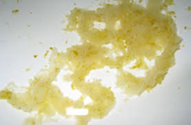 Image result for yellow stool human poop