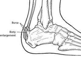 Haglund's deformity occurs when irritation to the heel bone causes it to grow a protrusion. Haglund S Deformity Foot Health Facts