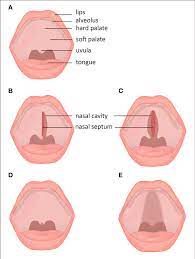Subtypes And Subclinical Forms Of Cleft Palate A Normal Lip And Download Scientific Diagram