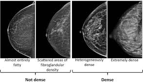 What does breast cancer look like on a mammogram? What S The Best Way To Screen Dense Breasts