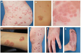 Image result for pruritic urticarial papules and plaques of pregnancy