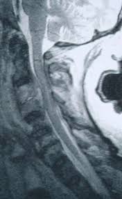 Image result for Spinal Epidural Abscess