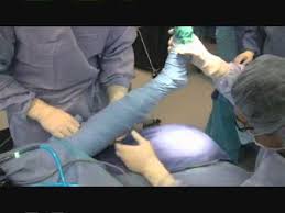 The mean visual analogue pain score dropped from 8.5 of 10 preoperatively to 2.5 of 10 postoperatively. Plantar Fasciitis Minimally Invasive Surgery Youtube