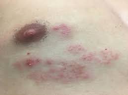 Your blood tests seem to indicate you do not have herpes. Varicella Zoster Meningitis An Atypical Case Of Zoster Reactivation In Immunocompetent Young Adult Bmj Case Reports