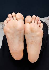 Image result for pompholyx soles of feet