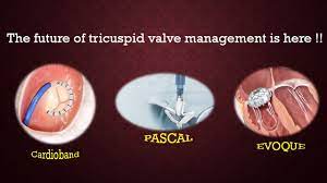 Transcatheter Therapies Future Of Tricuspid Regurgitation Management Glances From Europcr 2021