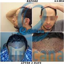 اعادة ترميم الخط الأمامي وتكثيف المنطقة الأمامية بدون حلاقة الشعر بالكامل تميز بإجراء عملية زراعة الشعر واستعد شبابك مع كلينيكانا لزراعة الشعر والتجميل للتو 2020