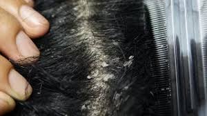 It's probably dried egg yolk or something and i don't know but i think he just puts the worms nests and stuff on the person's head. Best Of Flakes In Hair Free Watch Download Todaypk