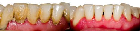 Brushing your teeth with a lot of pressure won't. Remove Tartar At Home Be Careful With Diy Tips Dental Freak