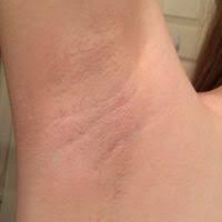 I have dark hair and light skin. Laser Hair Removal Reviews And Patient Experiences Zwivel