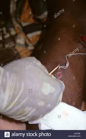 Der medinawurm | die medinawürmer. Guinea Worm Emerging Niger Stockfotos Und Bilder Kaufen Alamy