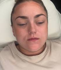 First time lip filler 💉 0.5ML ⏰ 30 minutes 🫣 Pain/Bearable highest  numbing cream applied 👄 Lasts 9/12 months 💵 £90 📩 DM to book 🌚 Late  night appointments available #revolax #injections #