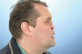 This is because the drug can stay within the tissues and hair follicles if taken for long periods of time to be completely out of the hair follicles. Cocaine And Oral Health British Dental Journal