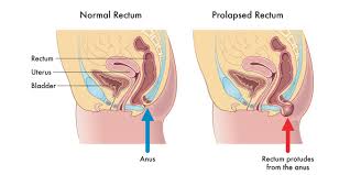 While this may be uncomfortable, it rarely results in an emergent. Difference Between Piles And Rectal Prolapse Pristyn Care