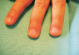 Beau's lines are horizontal indentations, or ridges, that develop across the nails. Ready To Use Therapeutic Food Rutf In The Management Of Severe Acute Malnutrition In India
